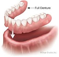 Full Dentures in Kingman