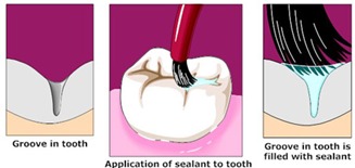 Dental Sealants in Kingman