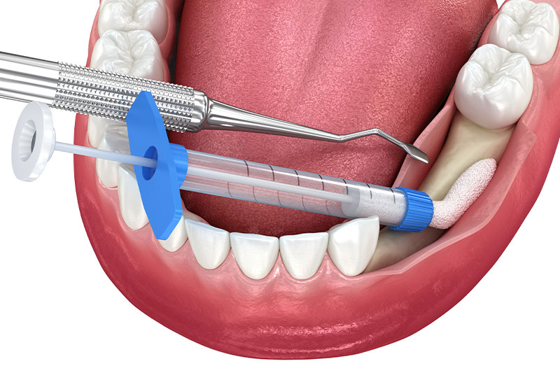 Bone Grafting in Kingman