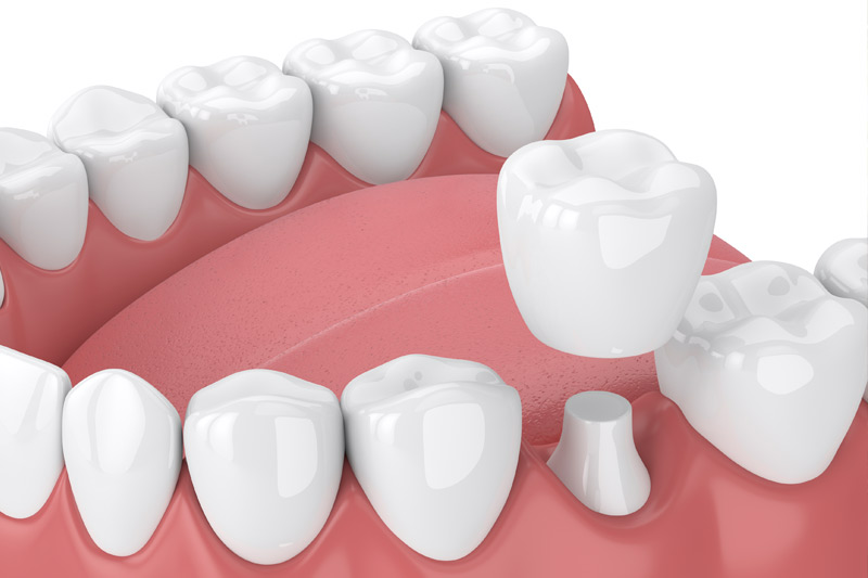 Dental Crowns in Kingman