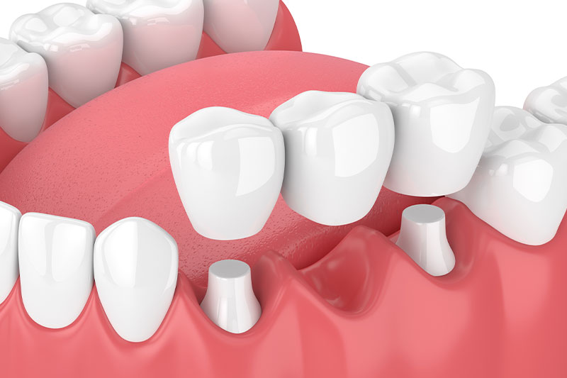 Dental Bridges in Kingman