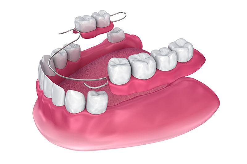 Partial dentures in Kingman
