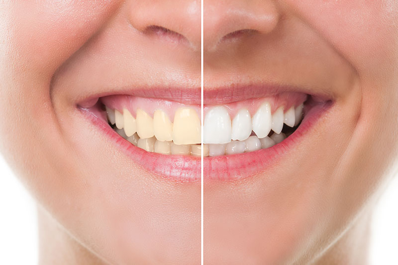 Teeth Whitening in Kingman