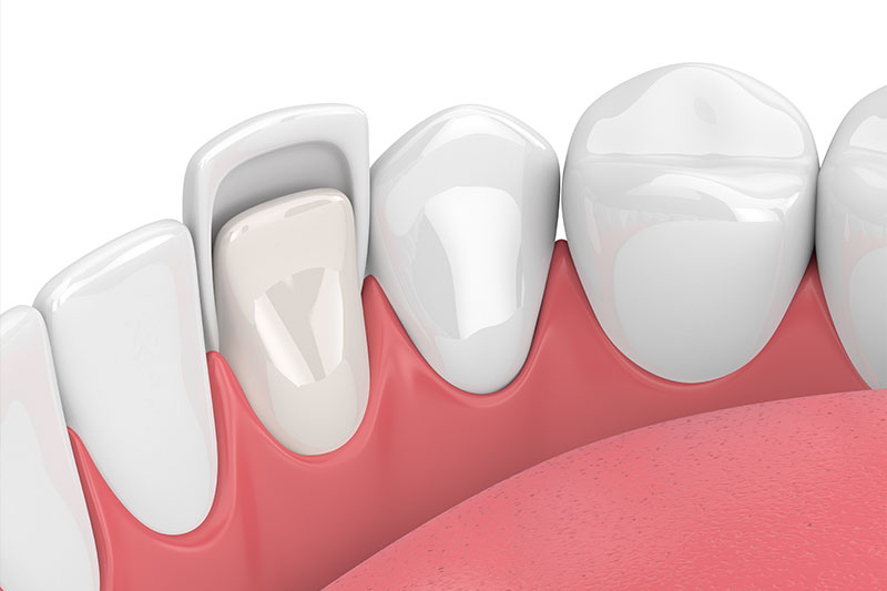 Veneers in Kingman