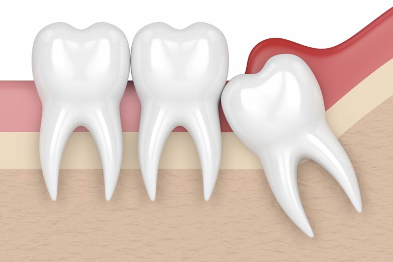 Tooth Extractions in Kingman